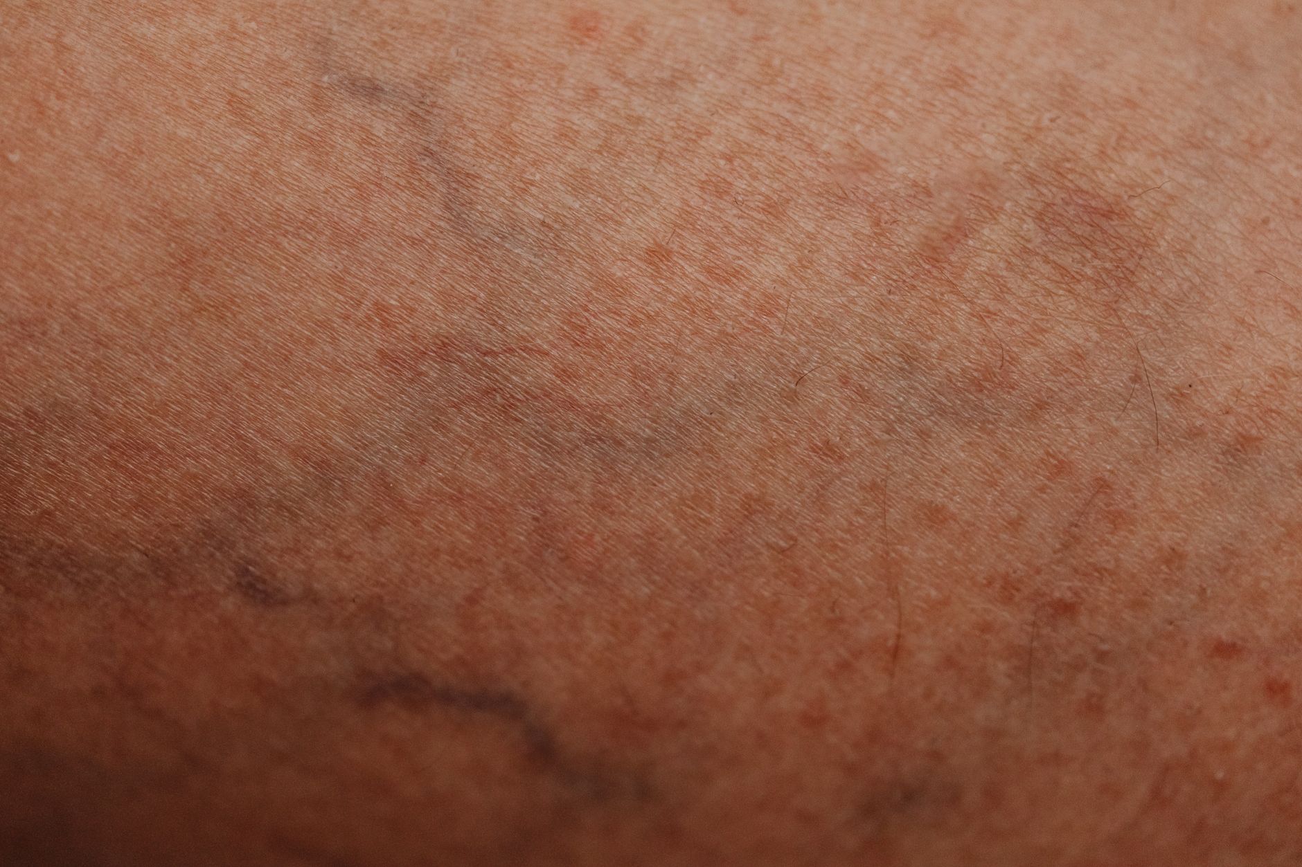 Varices : les symptômes sérieux à ne jamais ignorer